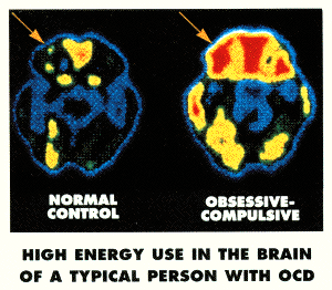 Brain scans reproduced from the original Westwood OCD educational article